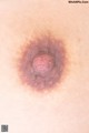 A close up of a woman's breast with a large lump on it.